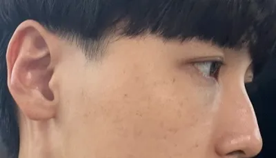 [顏面輪廓] 術後兩個月 - 眼、鼻、輪廓