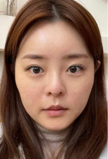 [鼻] 밍아밍어 - 眼、鼻、臉部抽脂