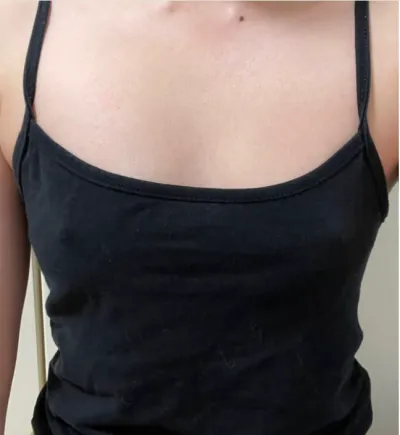 [隆胸] 你嚐過的餅乾 - 隆胸