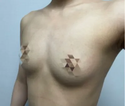 [隆胸] 飽滿 - 胸部