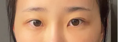 [眼部] 聽說了 - 眼部整形