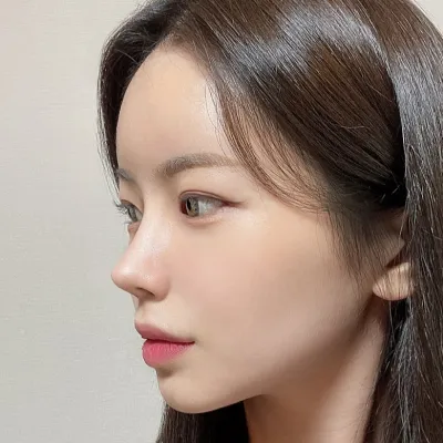 [鼻部] Dior - 鼻尖、鼻樑、截骨、鷹鉤鼻、歪鼻