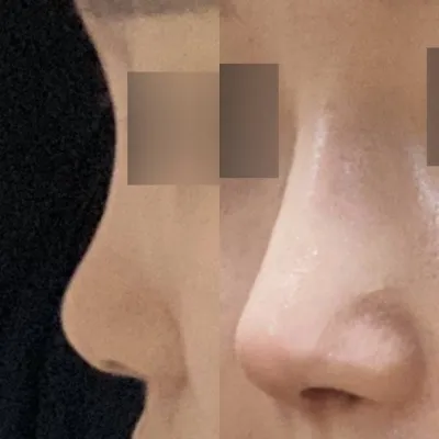 在Weavers做了第一次鼻子手術