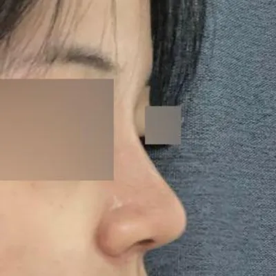 維沃斯整形外科 鼻部手術一個月後記