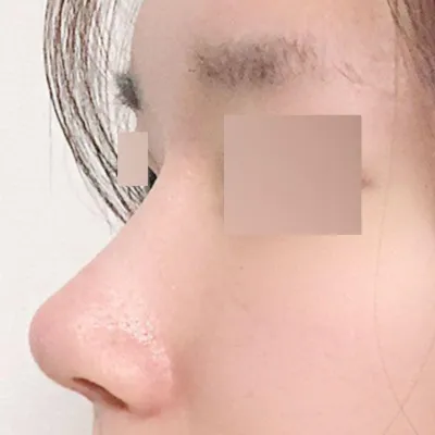 又小又扁的鷹鉤鼻手術一個月後記