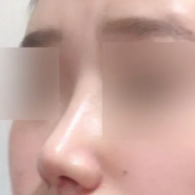 做完鼻部重修手術兩個月了