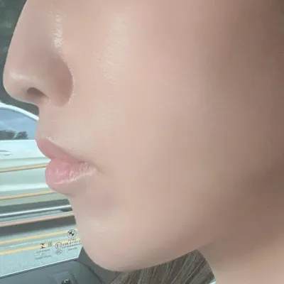 改善了令人煩惱的法令紋！