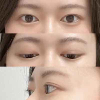 埋線、眼部矯正後記