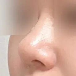 無假體蒜頭鼻改善手術後記