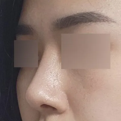 小鼻縮小手術已經2個月了！