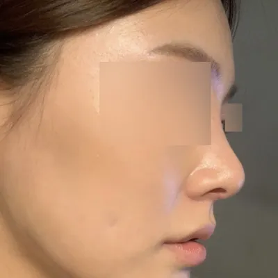 隆鼻手術兩個月後記：效果遠勝玻尿酸隆鼻
