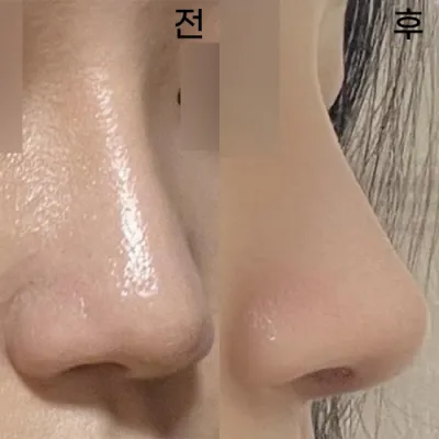 給代表院長做了鼻子重修手術已經1個月了