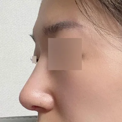 做了無假體鷹鉤鼻手術！