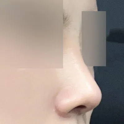 做完隆鼻手術一個月啦！