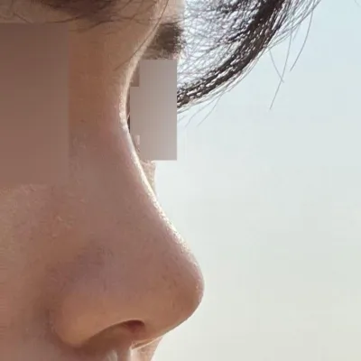 今天終於把裡面的線拆掉了！