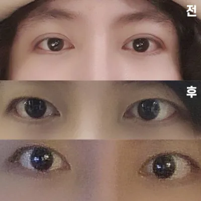 雙眼皮修復降低手術線後的經過