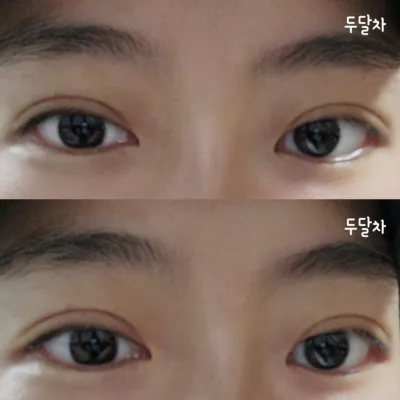 眼部手術兩個月的真實後記~^^