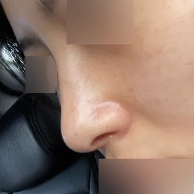 做了無假體隆鼻手術