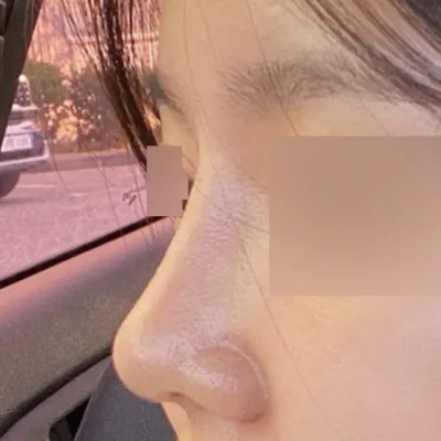 做了低鼻頭整形手術已經3個月了