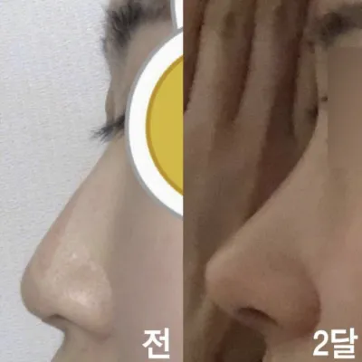 像男人一樣的鷹鉤鼻，手術後變得更時尚了！