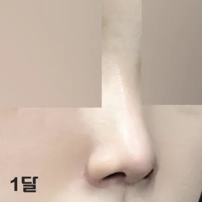 過了一個月，感覺腫脹消退得更快了~