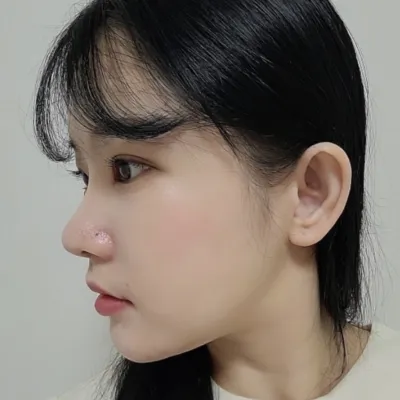 眼鼻重修手術過了一個月了