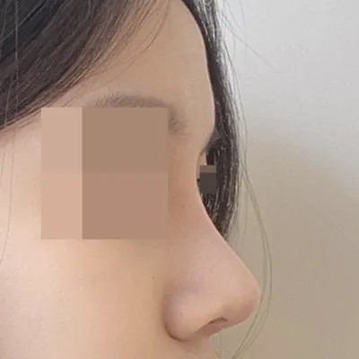 隆鼻手術3個月後記！