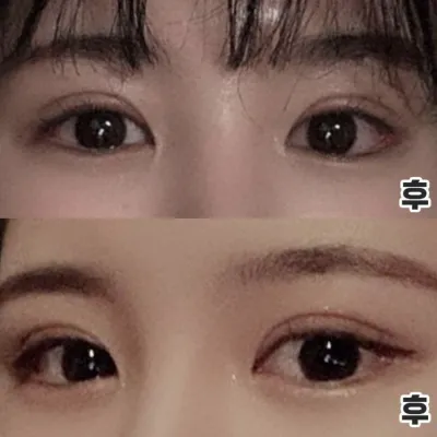 眼睛橫向變長了！重做手術成功後