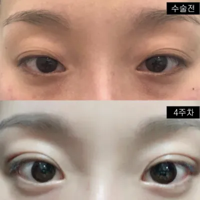 解決了下垂眼皮和多層皺紋的煩惱