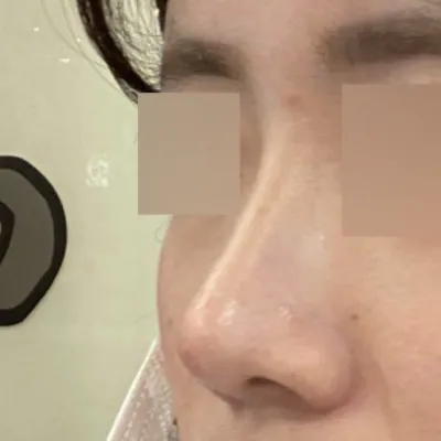 做完隆鼻手術已經兩個月了！