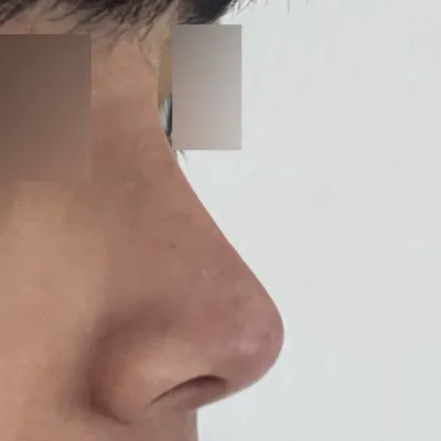做完鼻頭整形手術已經三個月了。