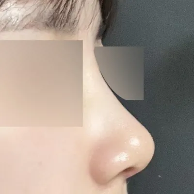 讓我自卑的鼻子變漂亮了！