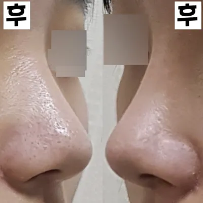 第一次做隆鼻手術已經兩週了！