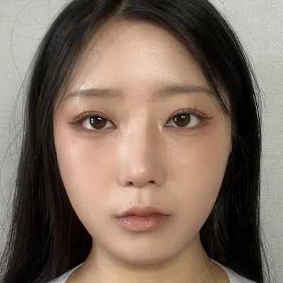 兩個月後，眼睛變得自然漂亮，位置也穩定了~