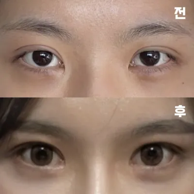 已經開始期待消腫後的樣子