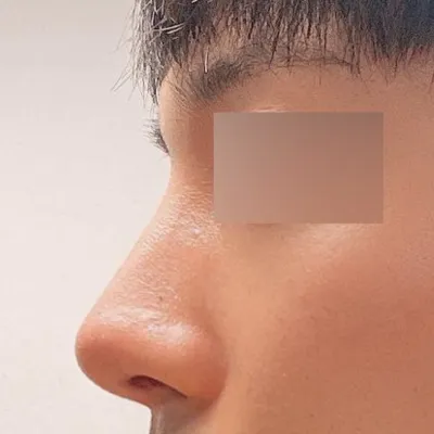 在維弗斯整形外科做手術已經六個月了