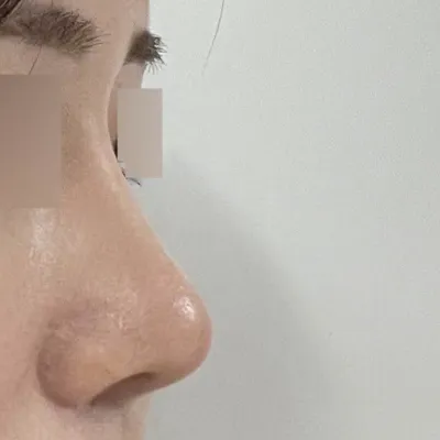 做完隆鼻手術已經3個月了！