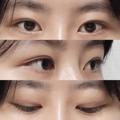 眼睛也在2週內消腫，沒有疤痕，非常乾淨！