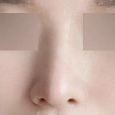 做完隆鼻手術已經6個月了