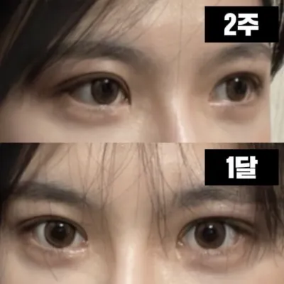 拆線後感覺時間飛逝！