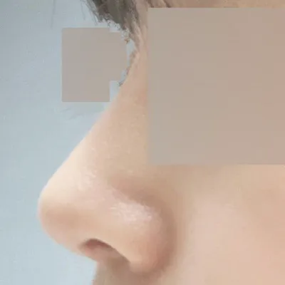 在維瓦斯整形外科做完隆鼻手術已經兩個月了