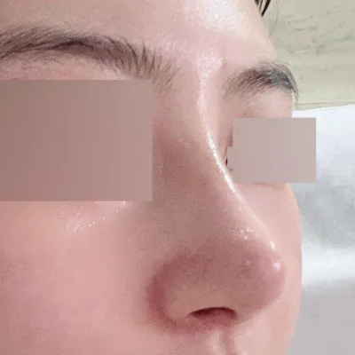 感謝為我打造理想鼻子的徐承曹院長！