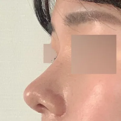 在WiiVerse整形外科做眼鼻手術一個月後的後記！！