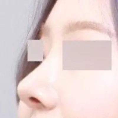 做了鷹鉤鼻手術已經6個月了，呵呵