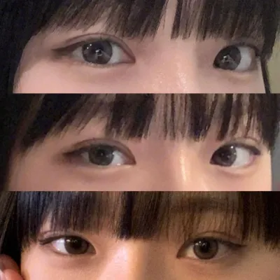 做了眼部修復手術和隆鼻手術！