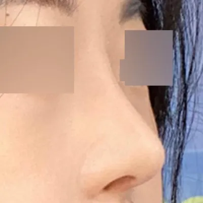 手術已經兩個月了，非常滿意。