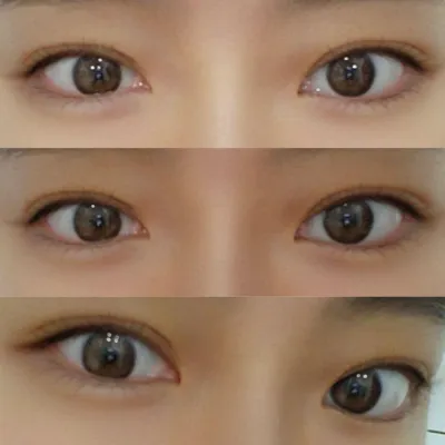 在沈正煥院長那裡做了非切開眼型矯正!