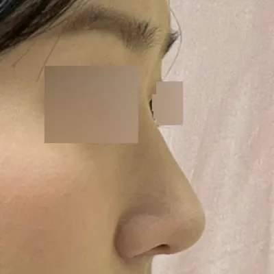 非常滿意你給我做的新鼻子，哈哈