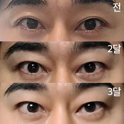 做了雙眼皮切開術3個月了。