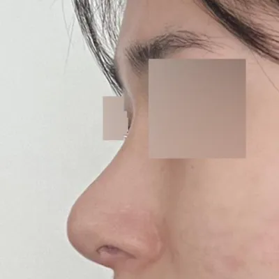 在維弗斯整形外科醫院做隆鼻手術已經兩個月了。